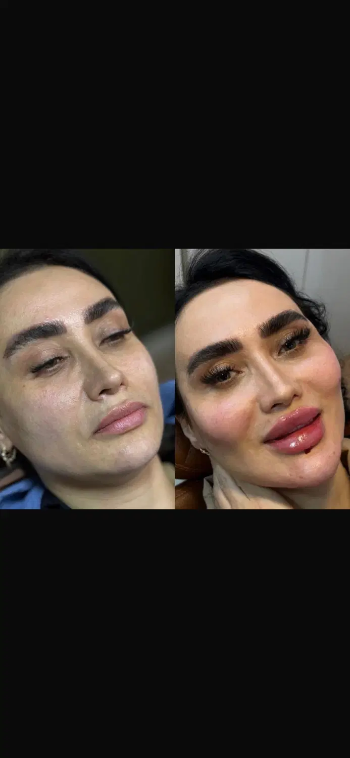 ژل وبوتاکس نورامیس فقط وفقط ۹۹۹|خدمات زیبایی و سلامت|تهران, سجاد|دیوار
