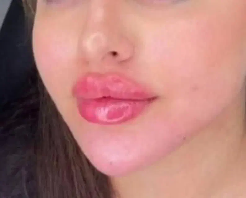 مزوژل آنزیم چربی اگزوزوم بادی بایوفیلر لیفت ژل ۴۹۰|خدمات آرایشگری و زیبایی|کرج, گوهردشت|دیوار