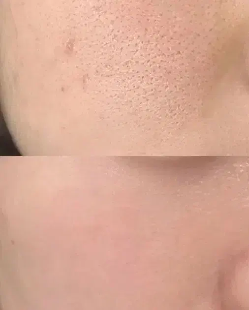 پاکسازی و جوانسازی پوست با تجهیزات پیشرفته|خدمات آرایشگری و زیبایی|رشت, گلسار|دیوار