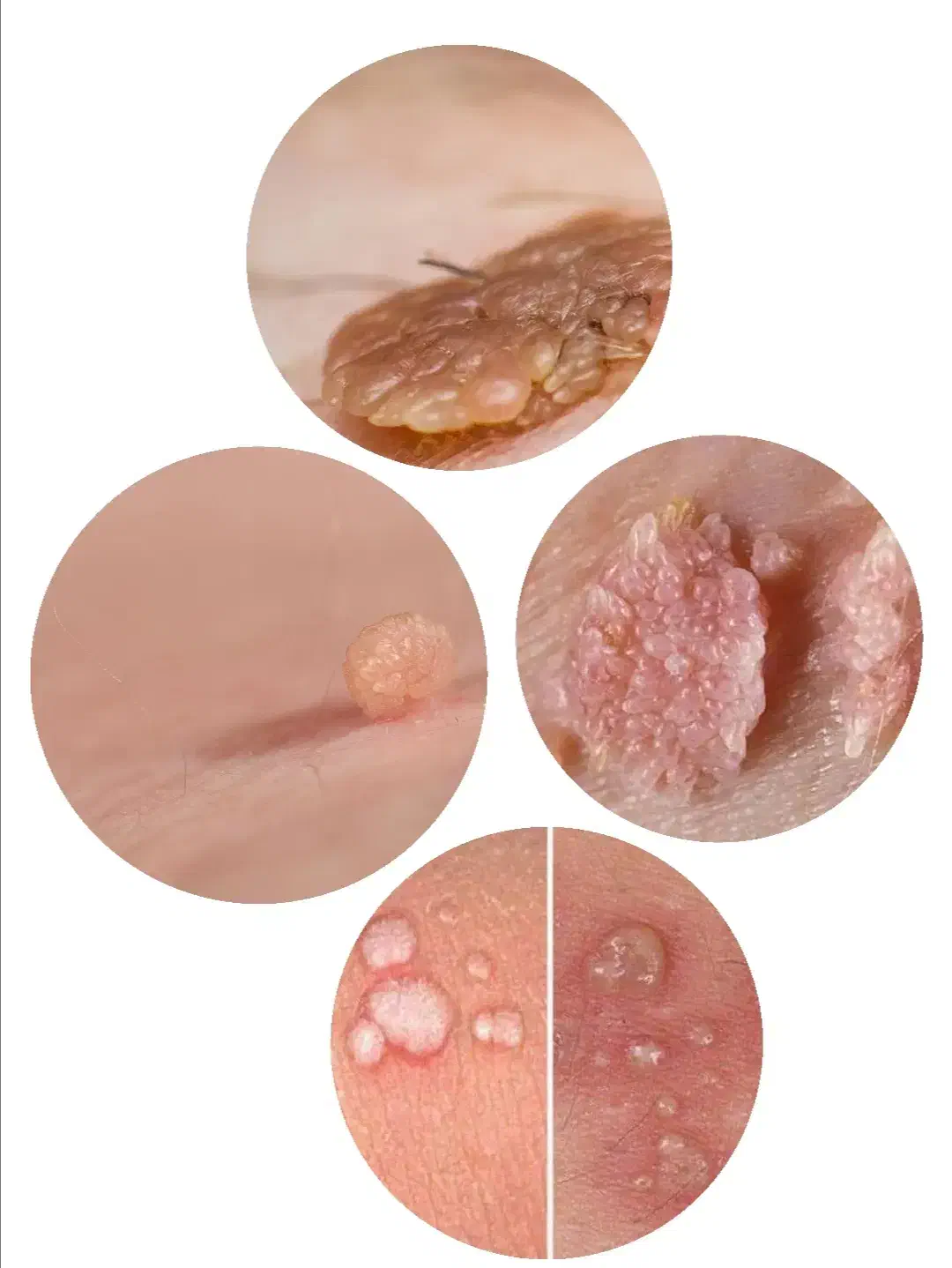 رفع دائمی زگیل وتبخال|آرایشی، بهداشتی، درمانی|قزوین, |دیوار