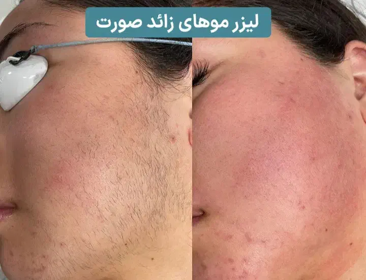 لیزر موژان|خدمات آرایشگری و زیبایی|تهران, اتابک|دیوار