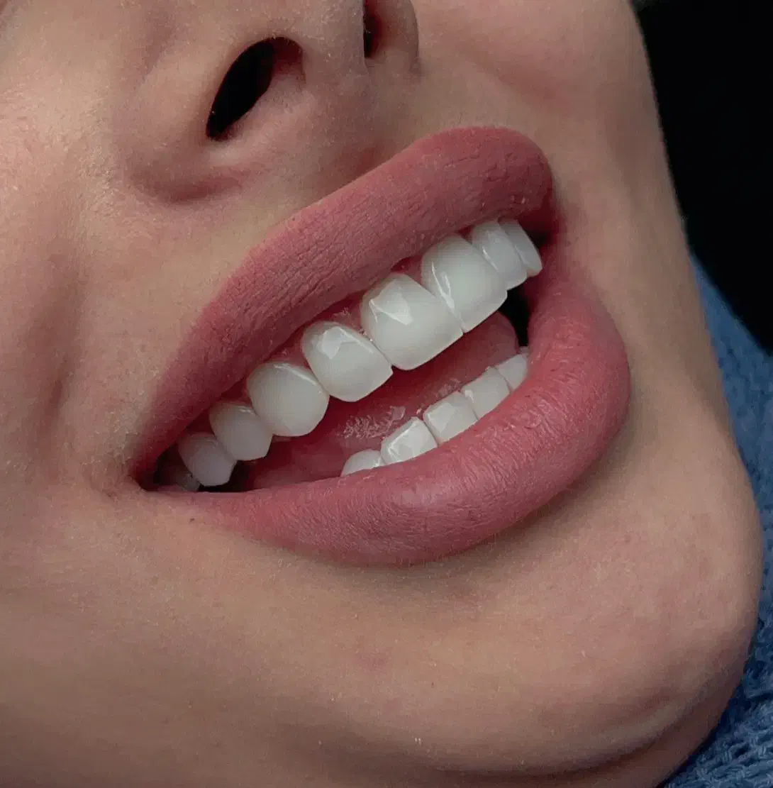 کامپوزیت دندان/تخفیف ویژه|خدمات آرایشگری و زیبایی|تهران, ایوانک|دیوار