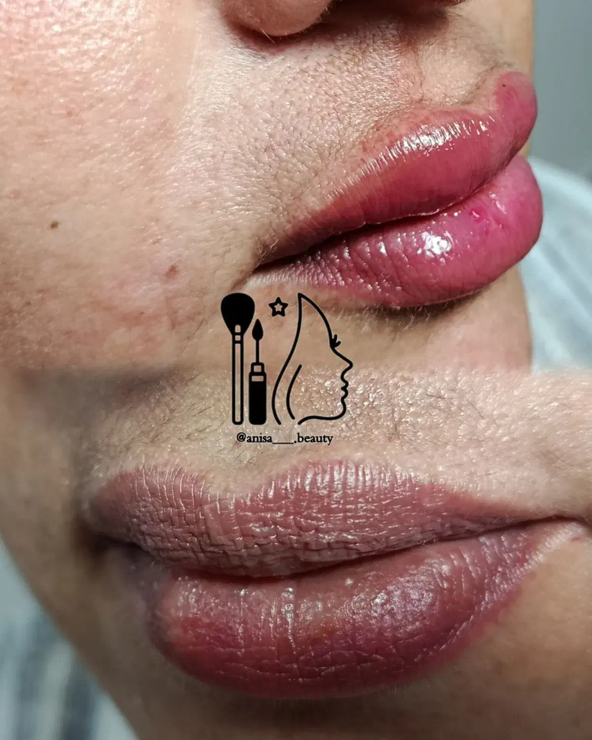 تزریق ژل و بوتاکس|خدمات آرایشگری و زیبایی|جهرم, |دیوار