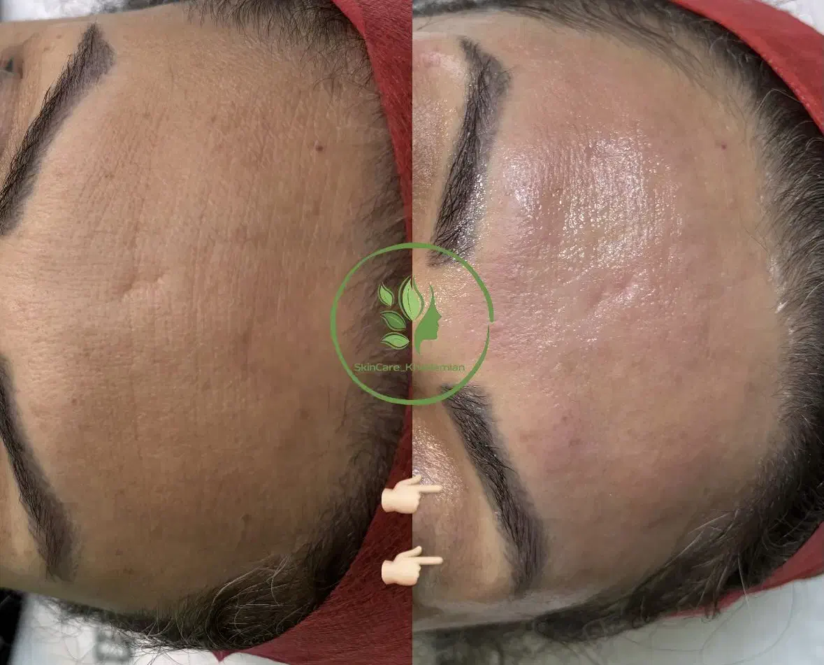 فیشال کامل ۳۸۰ (پاکسازی پوست) حرفه ای به مدت محدود|خدمات آرایشگری و زیبایی|صدرا-فارس, فاز ۱|دیوار