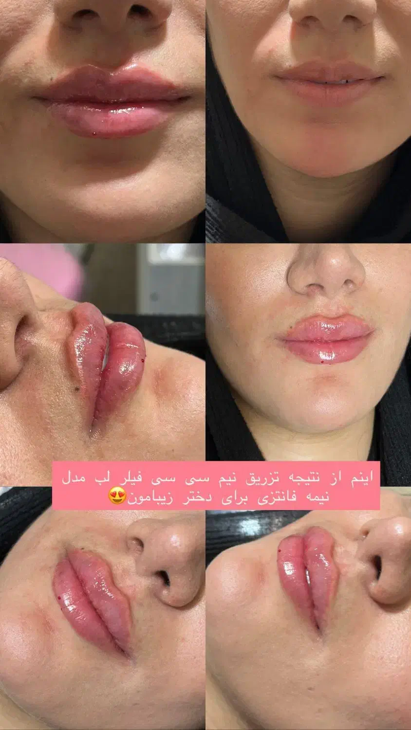 مطب زیبایی لیزر بوتاکس ژل مزو نخ لک جوش|خدمات آرایشگری و زیبایی|لردگان, |دیوار