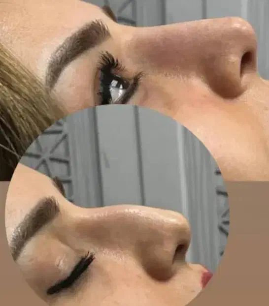 هایفو بوتاکس ژل لب زاویه سازی فیلر بادی هیپ سینه|خدمات آرایشگری و زیبایی|تهران, نارمک|دیوار