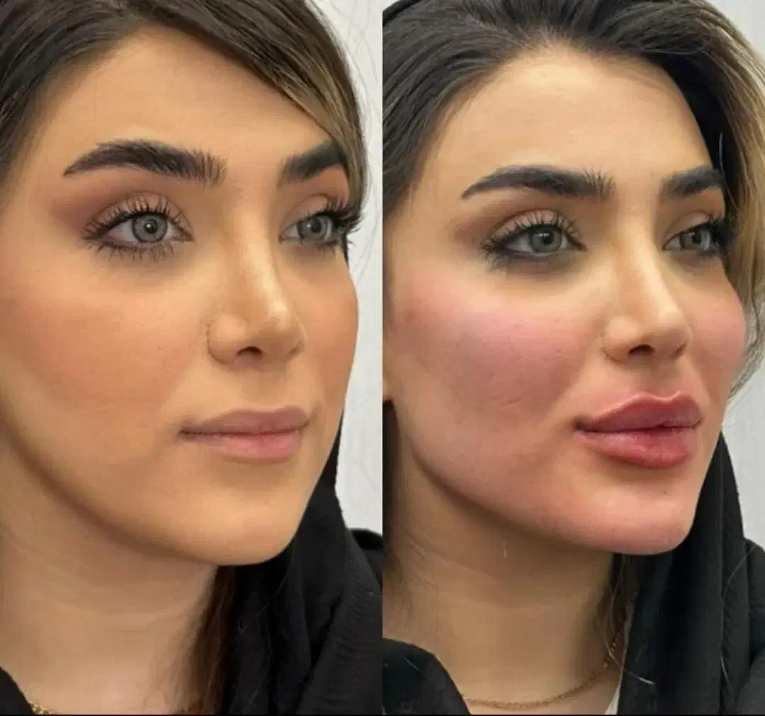 بوتاکس لیفت صورت فیلربادی بلفارو فیلرزاویه سانترال|خدمات آرایشگری و زیبایی|اصفهان, میرعماد|دیوار