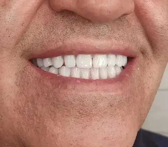 ساخت و تعمیر دندان مصنوعی/مواد آلمانی/نقد و اقساط|خدمات آرایشگری و زیبایی|چناران, |دیوار