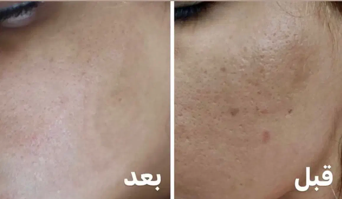 لیزرکیوسوییچ وایتینینگ پاکسازی هالیوودی سفید کننده|خدمات آرایشگری و زیبایی|اسلام‌شهر, زرافشان|دیوار