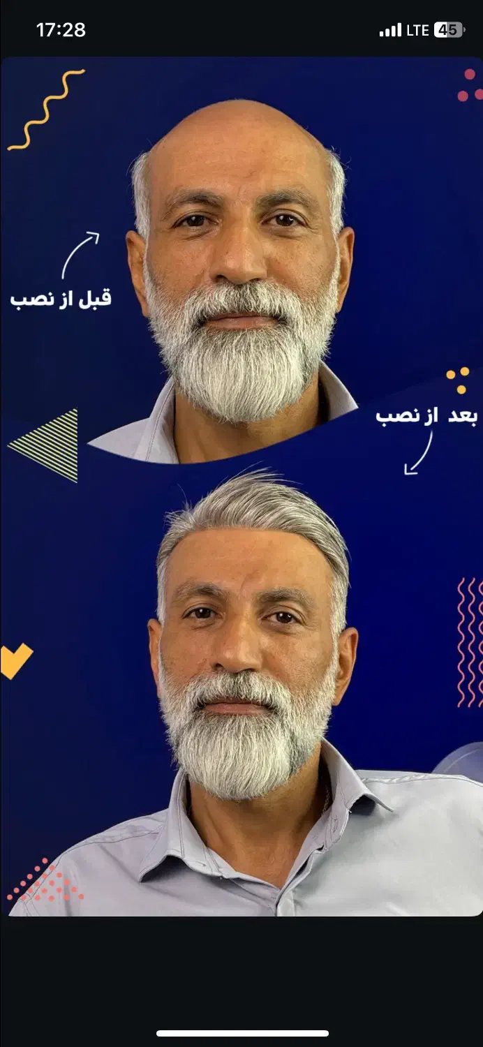 کاشت مو‌بدون جراحی  (پروتز مو‌بدون‌چسب)|خدمات آرایشگری و زیبایی|درگهان, |دیوار