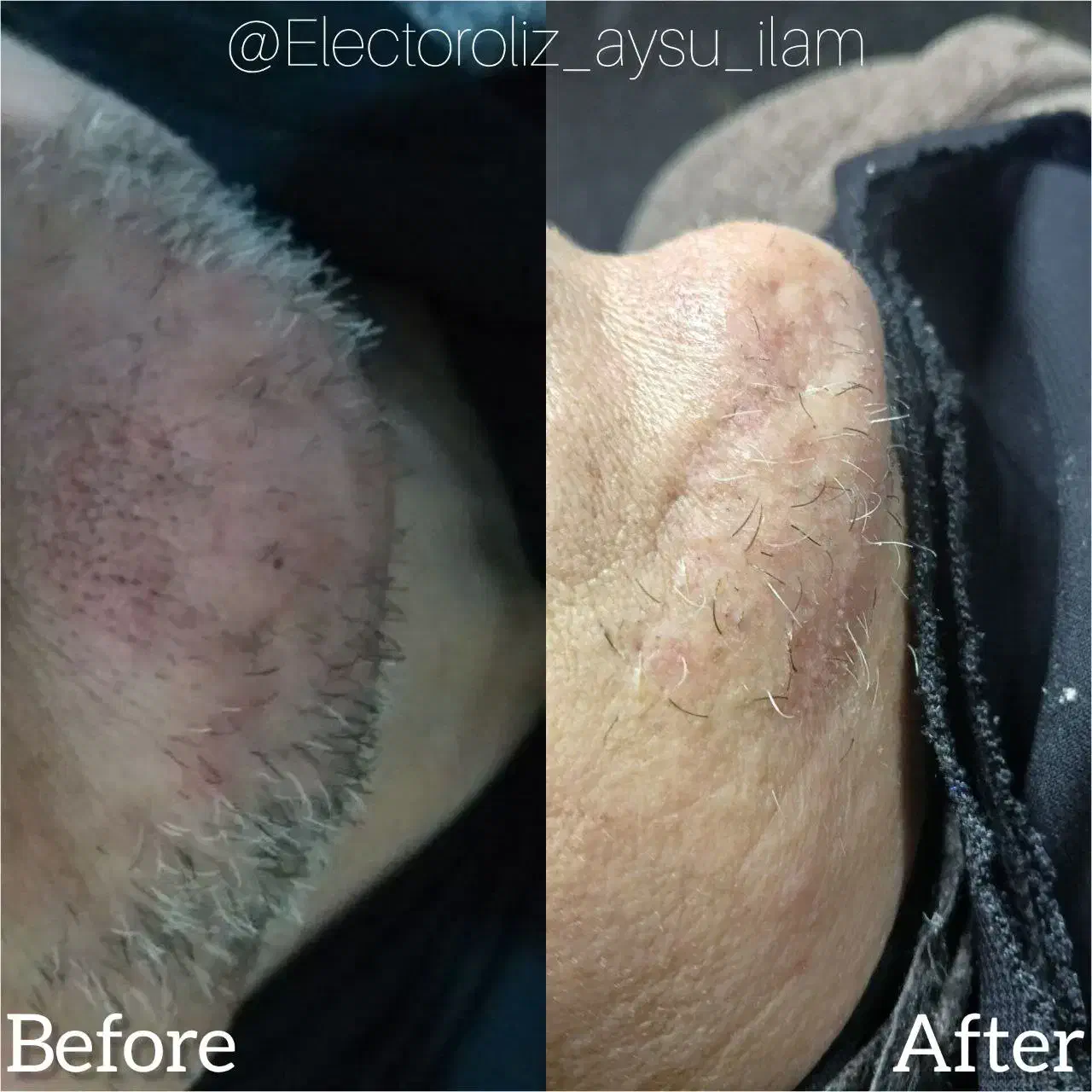 الکترولیز برای همیشه از شر موهای سفید خلاص شوید|آرایشی، بهداشتی، درمانی|ایلام, |دیوار