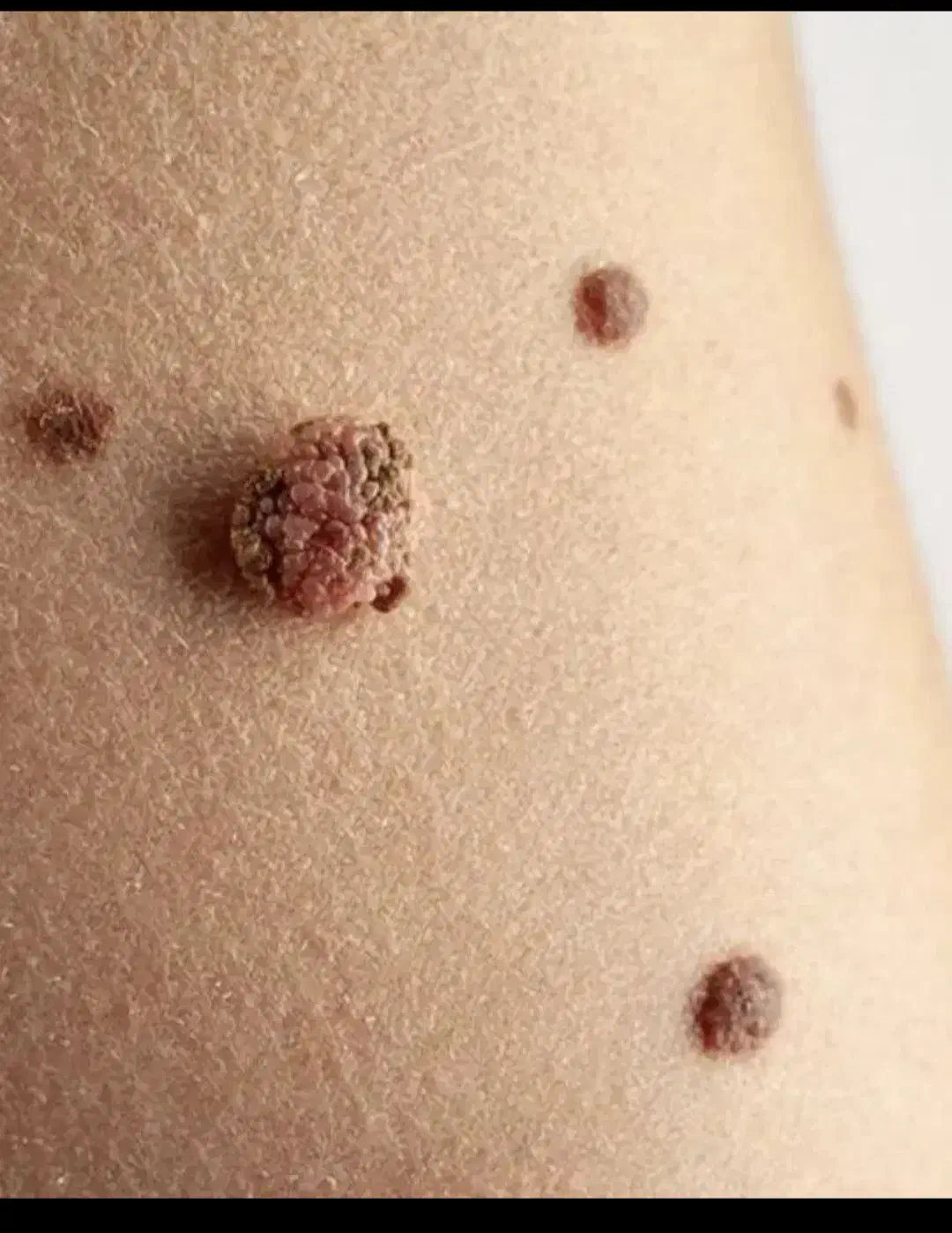 بهبود و کنترل زگیل تناسلی با مکملات کاملن گیاهی|آرایشی، بهداشتی، درمانی|گرگان, |دیوار