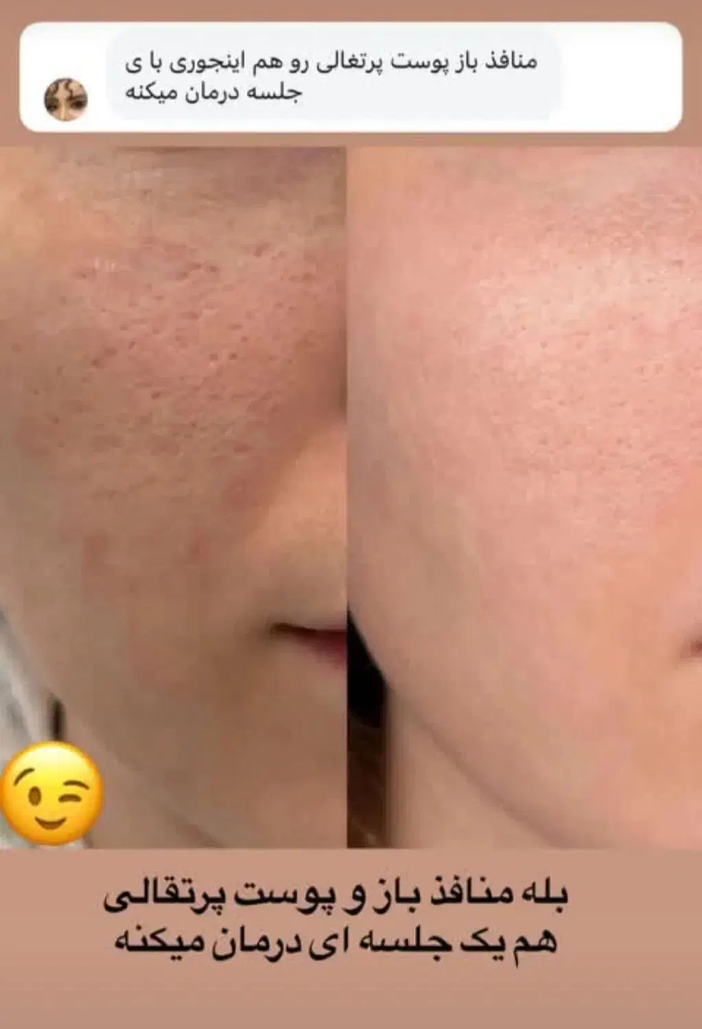 من اسکار،ولک پوستتو درمان میکنم بدون سوزن ودرد|خدمات آرایشگری و زیبایی|کاشان, دشت چال|دیوار