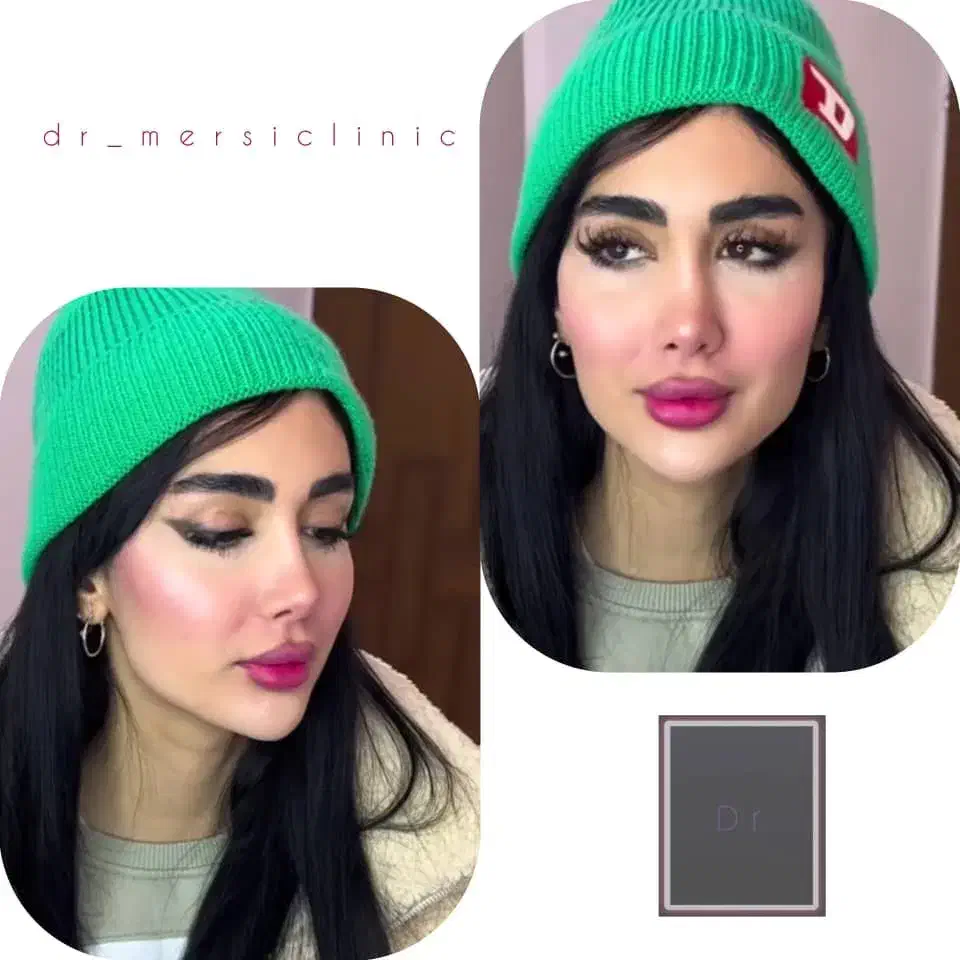 فوری فوری تخفیف٪۵۰ ژل بوتاکس برای شب یلدا|خدمات آرایشگری و زیبایی|اردبیل, |دیوار