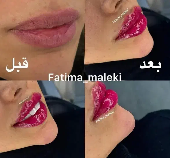 آفر ویژه آموزش حرفه ای فیلر و بوتاکس تا آخر هفته|خدمات آموزشی|تهران, هفت حوض|دیوار