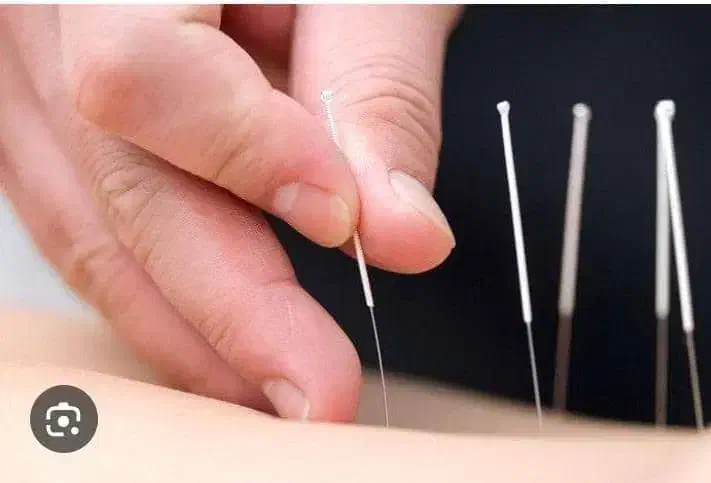 طب سوزنی و حجامت|آرایشی، بهداشتی، درمانی|فسا, |دیوار