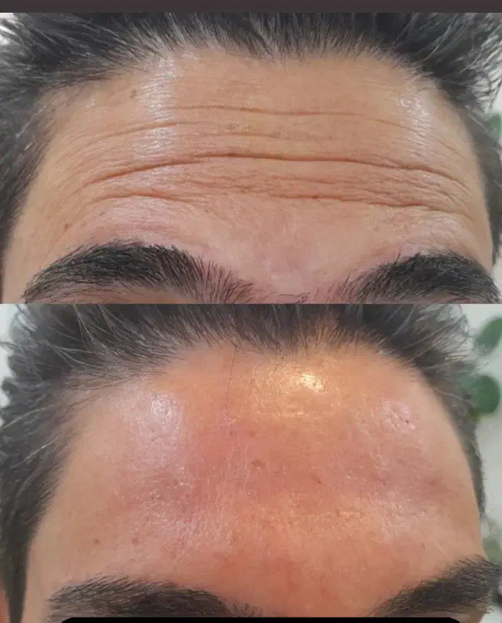 تخفیف ویژه بوتاکس، ژل، پی آر پی، رفع کک و مک|خدمات آرایشگری و زیبایی|بوکان, |دیوار