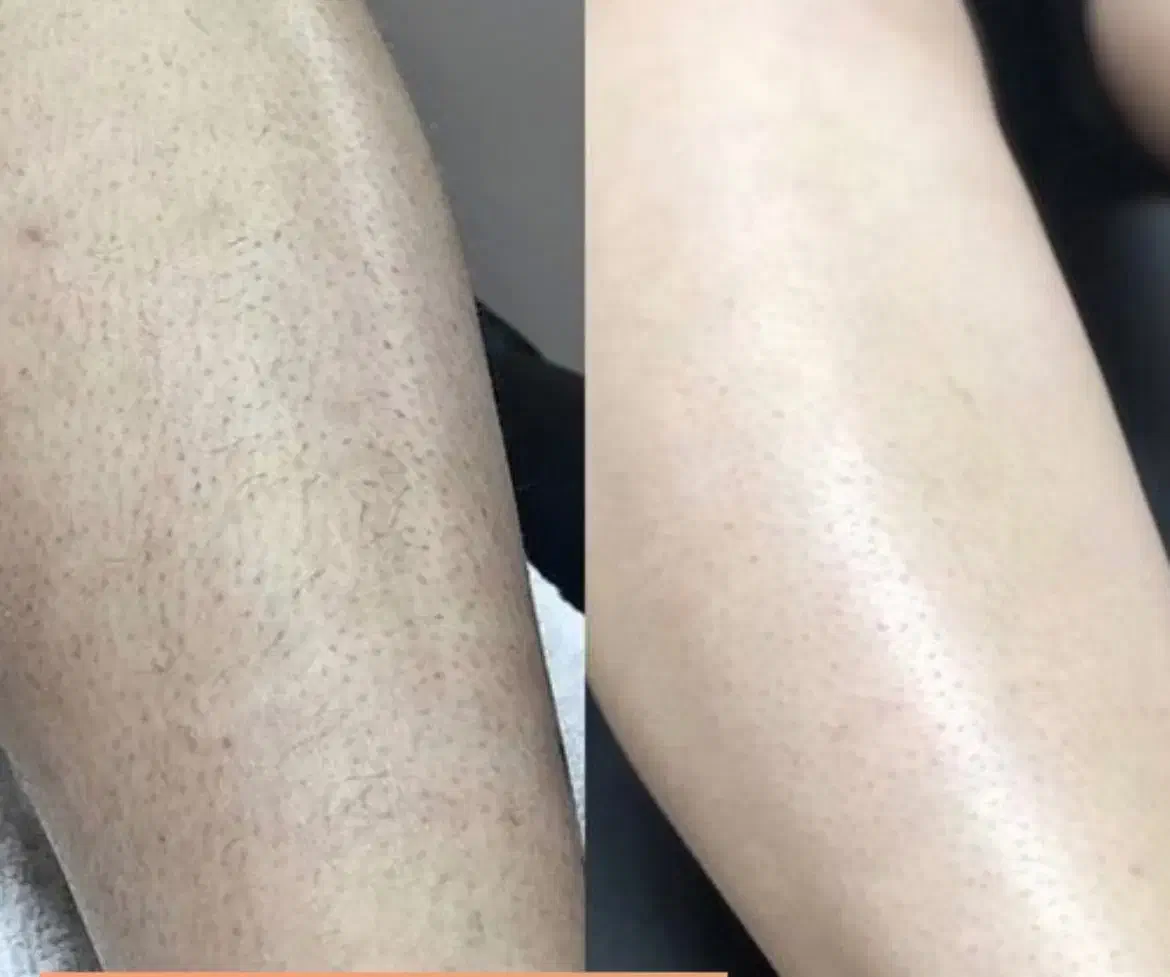 لیزر فقط ‌فقط 690تومان|خدمات آرایشگری و زیبایی|گنبد کاووس, |دیوار