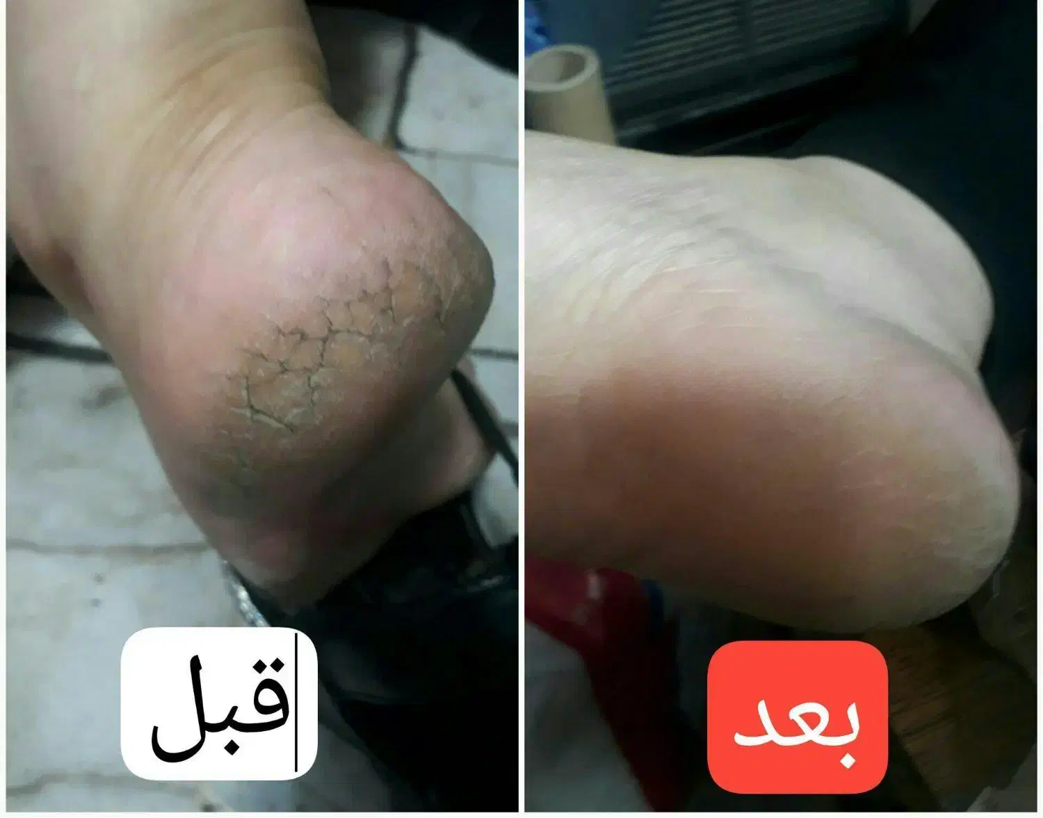 درمان خشکی و ترک پا|آرایشی، بهداشتی، درمانی|تربت جام, امام|دیوار