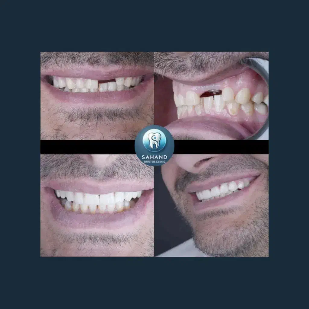 ایمپلنت دندان/فوری/دیجیتال/کاشت دندان/لمینیت|خدمات آرایشگری و زیبایی|تهران, سلسبیل شمالی|دیوار