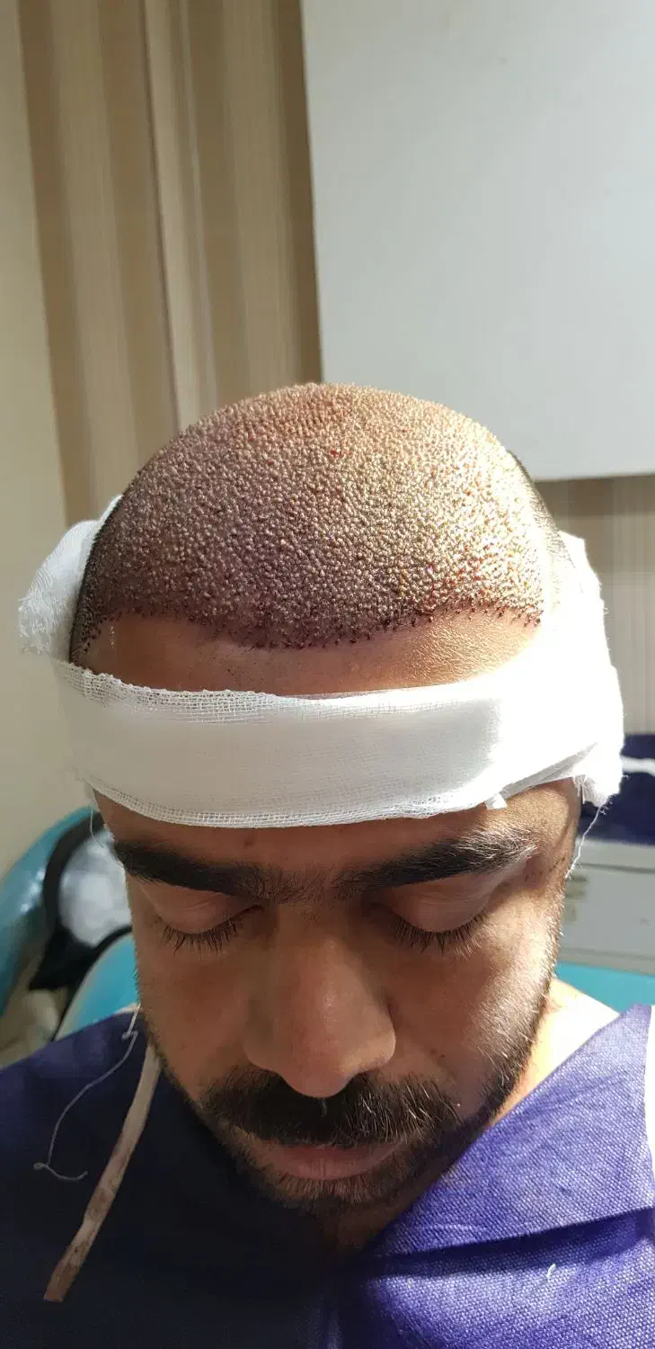 جشنواره کاشت مو دکتر راکعی .اقساط ۱۲ ماهه بدون سود|خدمات آرایشگری و زیبایی|اراک, |دیوار