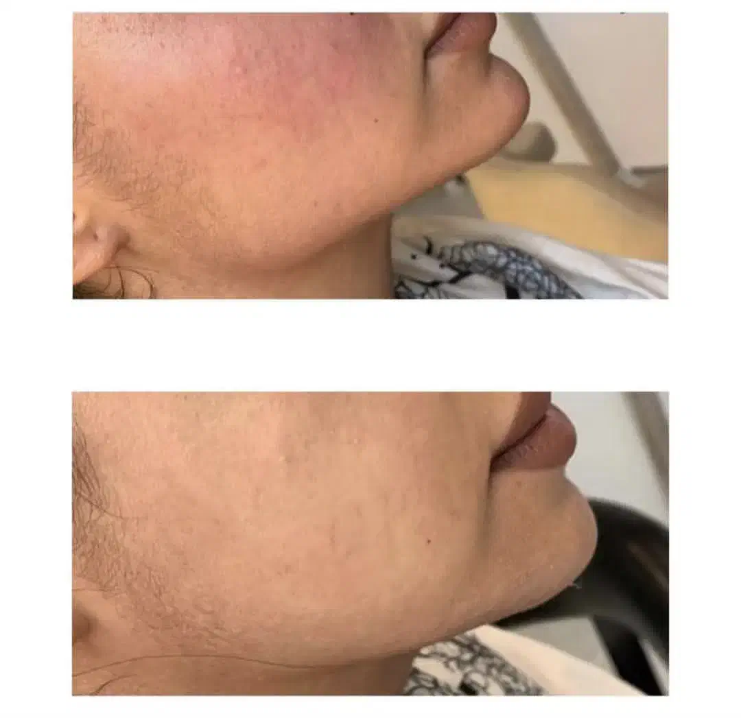 تزریق فیلر، بوتاکس، مادلینگ زیر نظر متخصص|خدمات آرایشگری و زیبایی|کرمانشاه, |دیوار