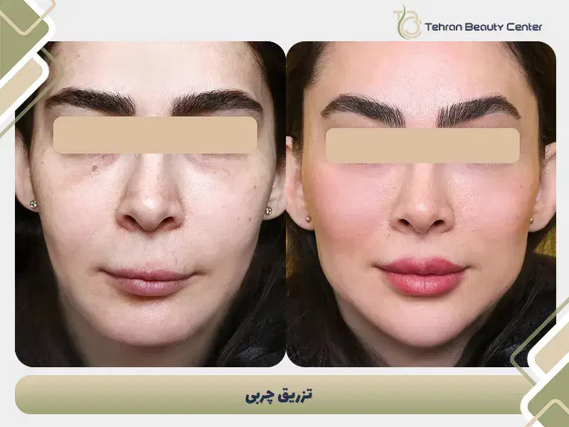 تور جراحی زیبایی قسطی|خدمات آرایشگری و زیبایی|کیش, |دیوار