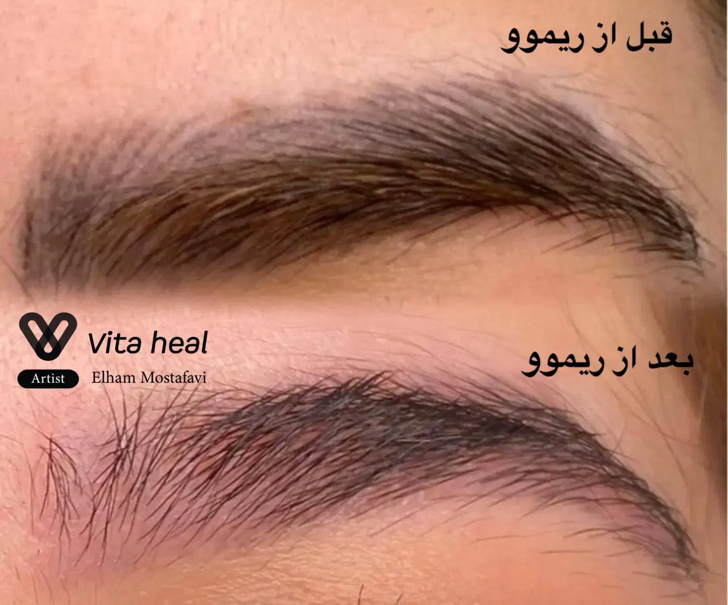 تخفیف ۵۰ درصدی ریموو تخصصی تاتو|خدمات آرایشگری و زیبایی|شیراز, تندگویان|دیوار