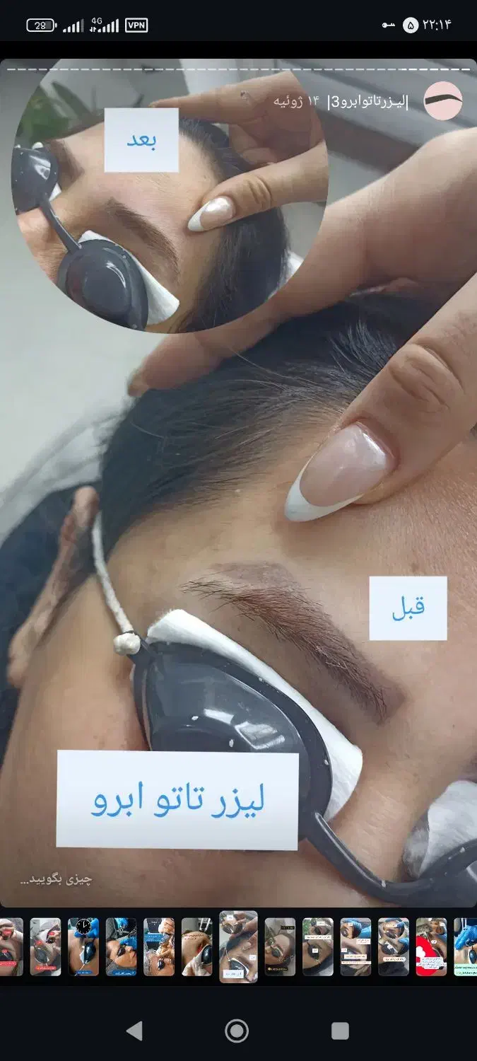 پاککردن تاتو صورت و بدن.تخفیف تا پایان هفته|خدمات آرایشگری و زیبایی|کرمانشاه, |دیوار