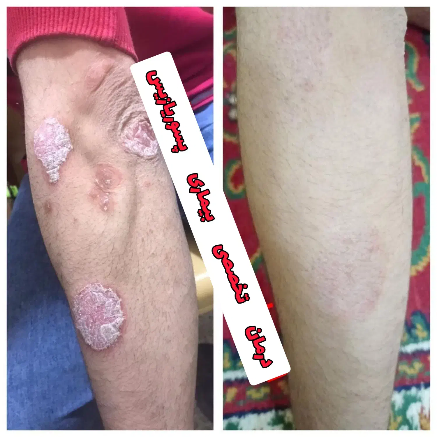 درمان ریشه ای و بدون بازگشت پیسی و پسوریازیس|آرایشی، بهداشتی، درمانی|شیراز, حافظیه|دیوار