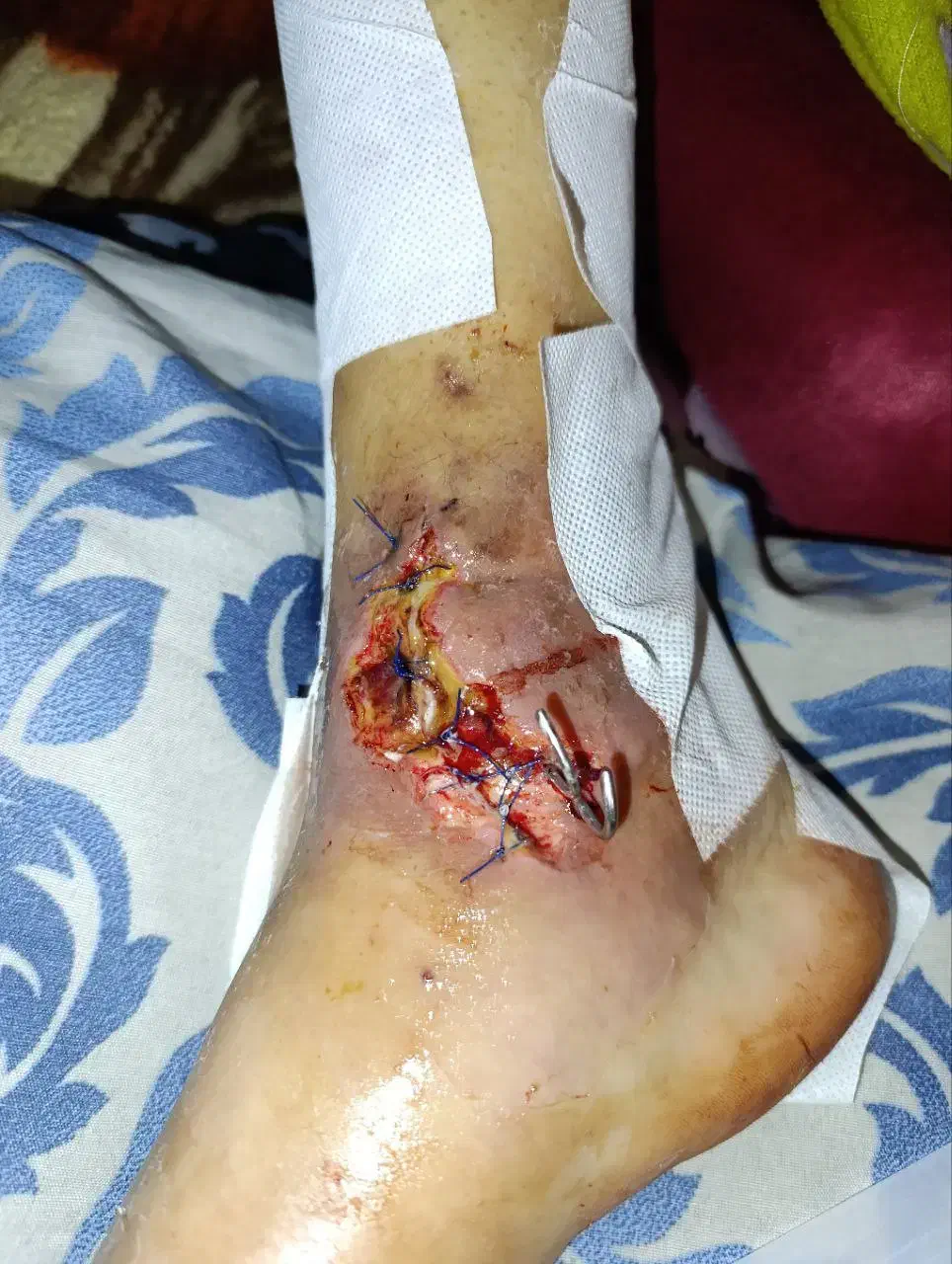 ویزیت تخصصی زخم در منزل-توسط کارشناس مجرب|خدمات آرایشگری و زیبایی|صومعهسرا, |دیوار