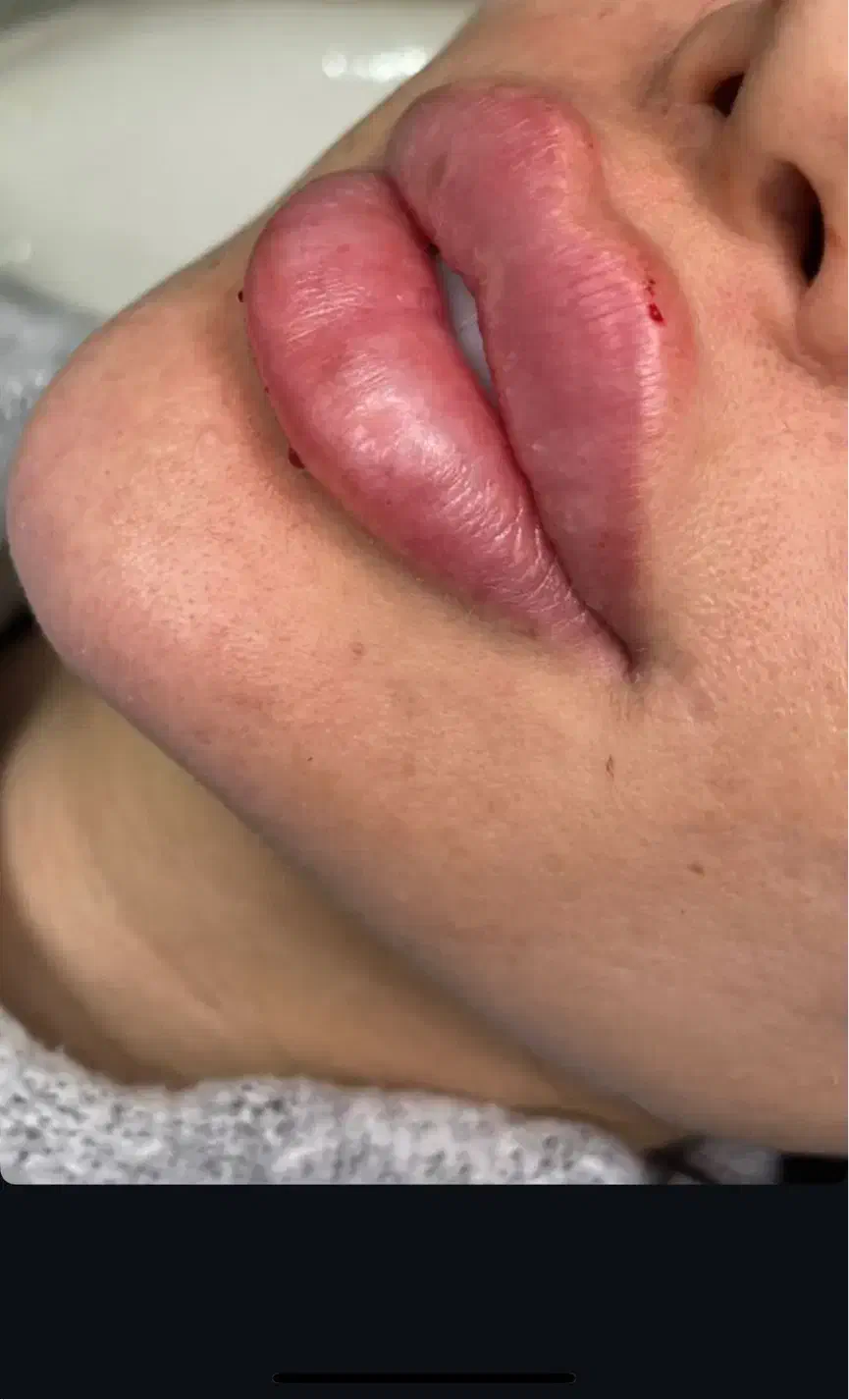 تزریق ژل لب و مادلینگ کامل صورت ب روش روسی وعربی|خدمات آرایشگری و زیبایی|قرچک, زیبا شهر|دیوار