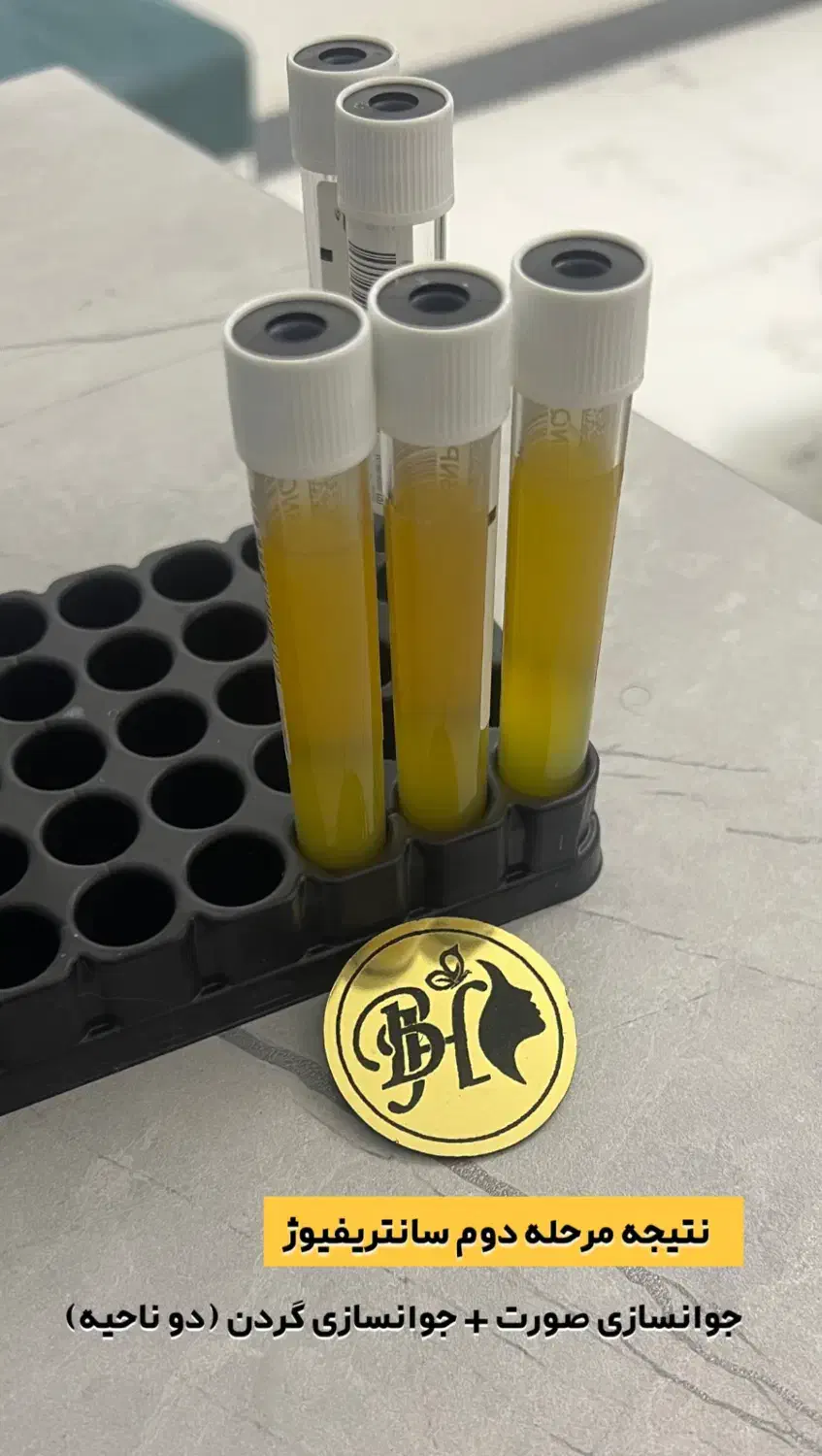 پی ار پی برای جوانسازی صورت، قطع ریزش مو، prp رشت|خدمات آرایشگری و زیبایی|رشت, گلسار|دیوار