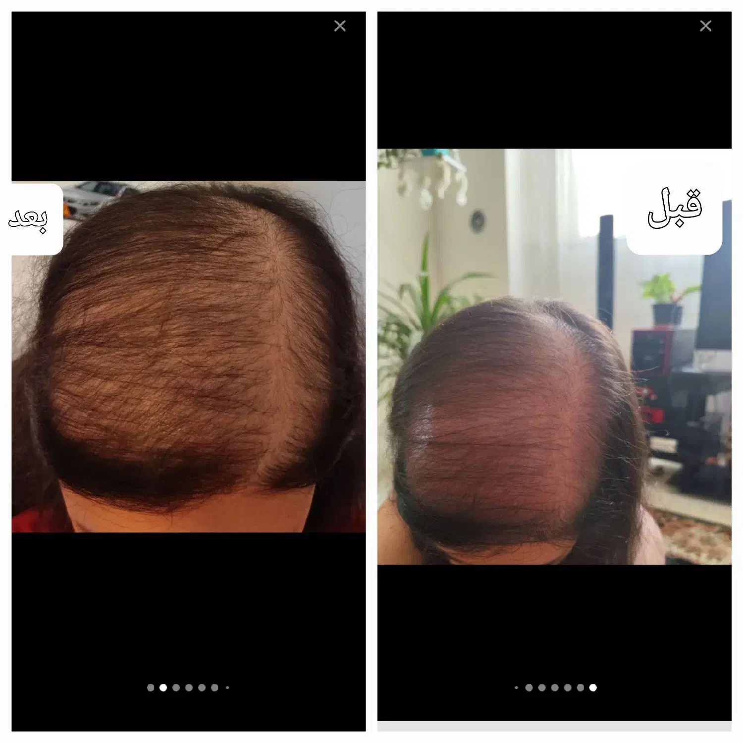 قطع ریزش مو /ورویش مجدد /صددرصد ارگانیک|آرایشی، بهداشتی، درمانی|نیشابور, شهرک ولیعصر|دیوار