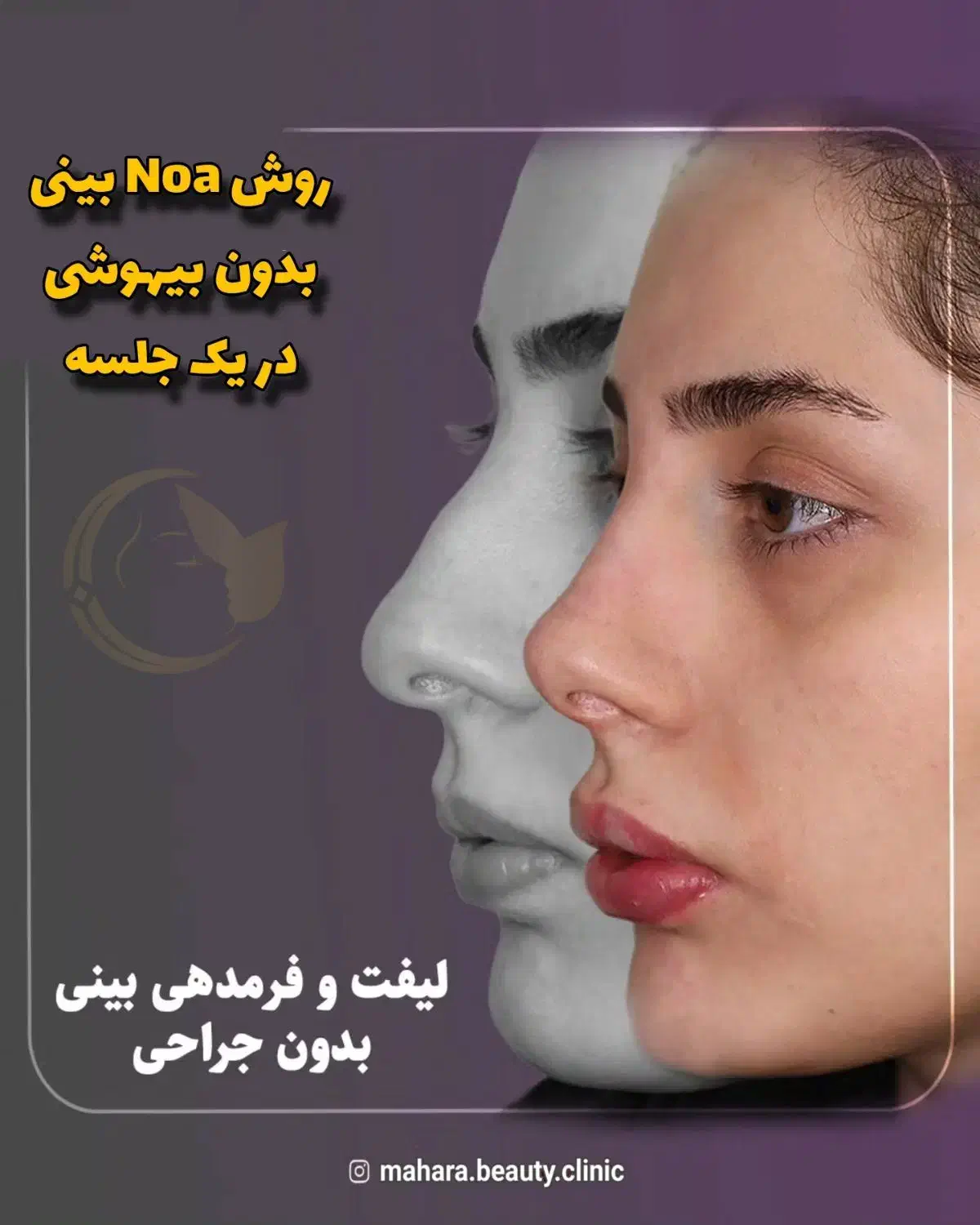 آف رینوپلاستی بینی بدون عمل جراحی NOA پزشک زیبایی|خدمات آرایشگری و زیبایی|مشهد, هفت تیر (آب و برق)|دیوار