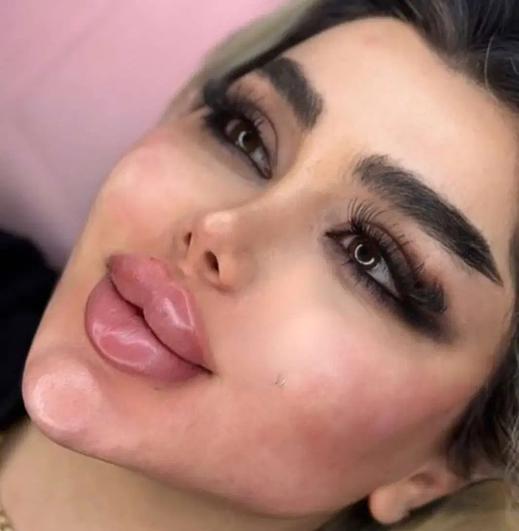 تزریق تخصصی ژل کانتورینگ صورت وزاویه فک وفیشیال|خدمات آرایشگری و زیبایی|کرج, گلشهر|دیوار