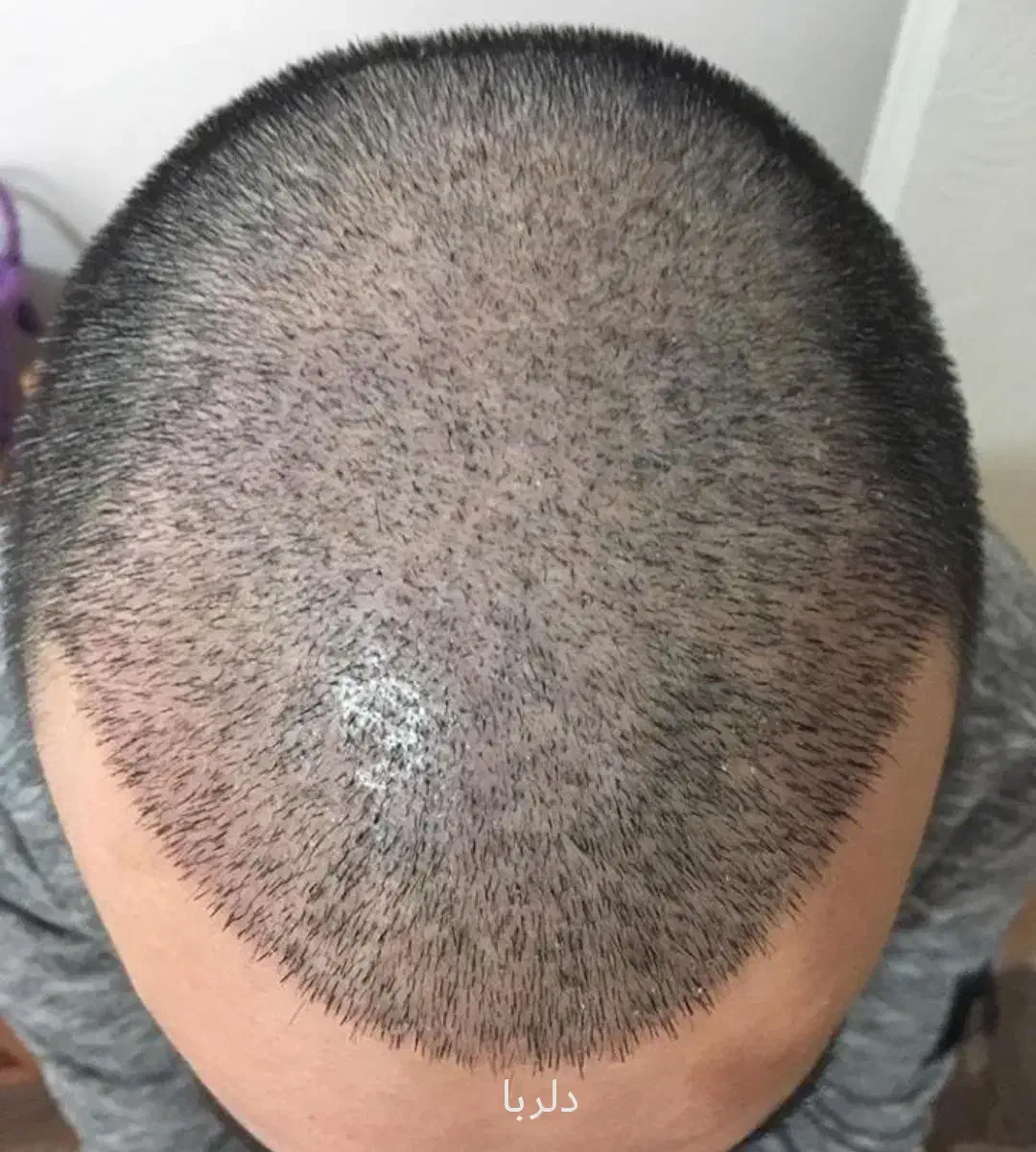 کاشت مو تخصصی دلربا شیراز|خدمات آرایشگری و زیبایی|بوشهر, |دیوار