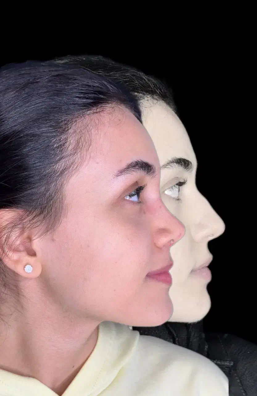 10 میلیون تخفیف عمل جراحی بینی بدون تامپون،لیفت|خدمات آرایشگری و زیبایی|فردیس, طالقانی|دیوار