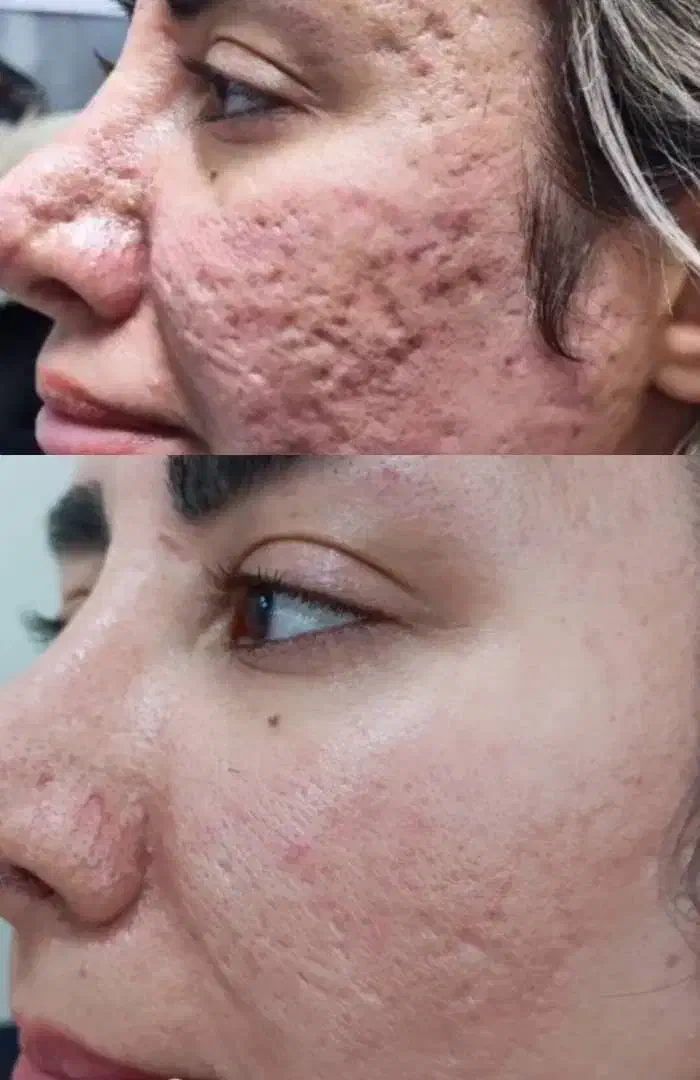 لیزر موفیشال لاغری پوست فیلر بوتاکس ویژه بانوان|خدمات آرایشگری و زیبایی|خمینی‌شهر, |دیوار