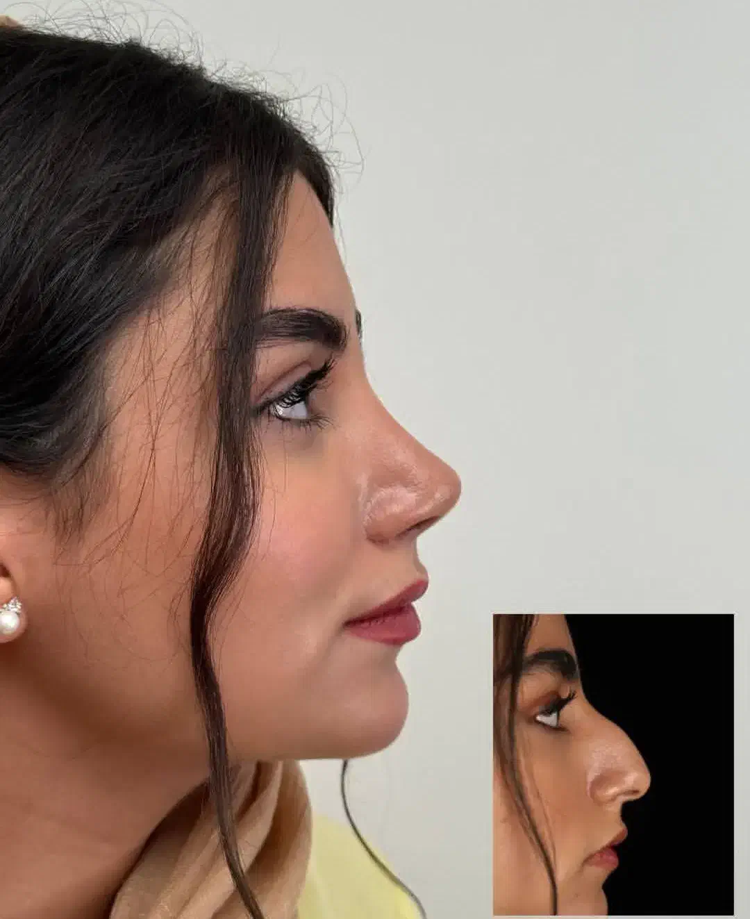 عمل بینی|خدمات آرایشگری و زیبایی|محمدشهر, محمدشهر|دیوار