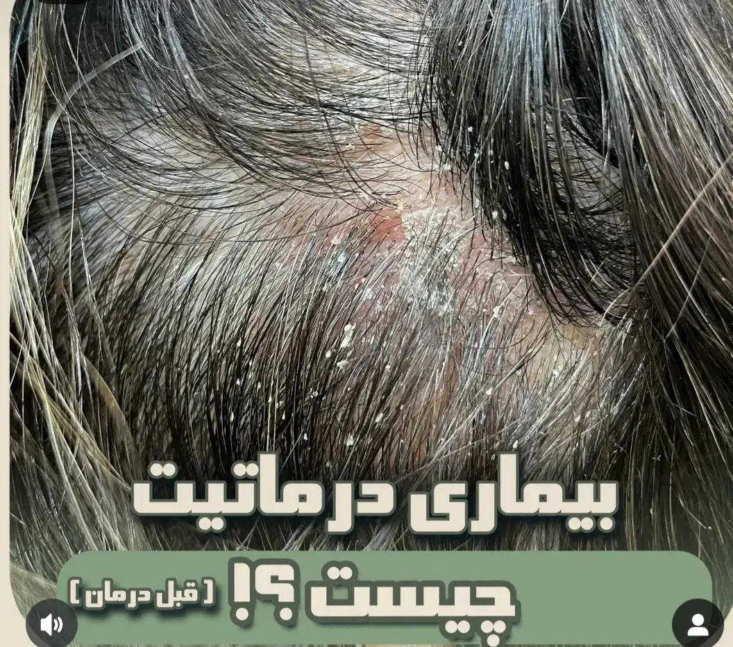درمان تخصصی ریزش مو و رفع کم پشتی مو|خدمات آرایشگری و زیبایی|قم, صدوق|دیوار