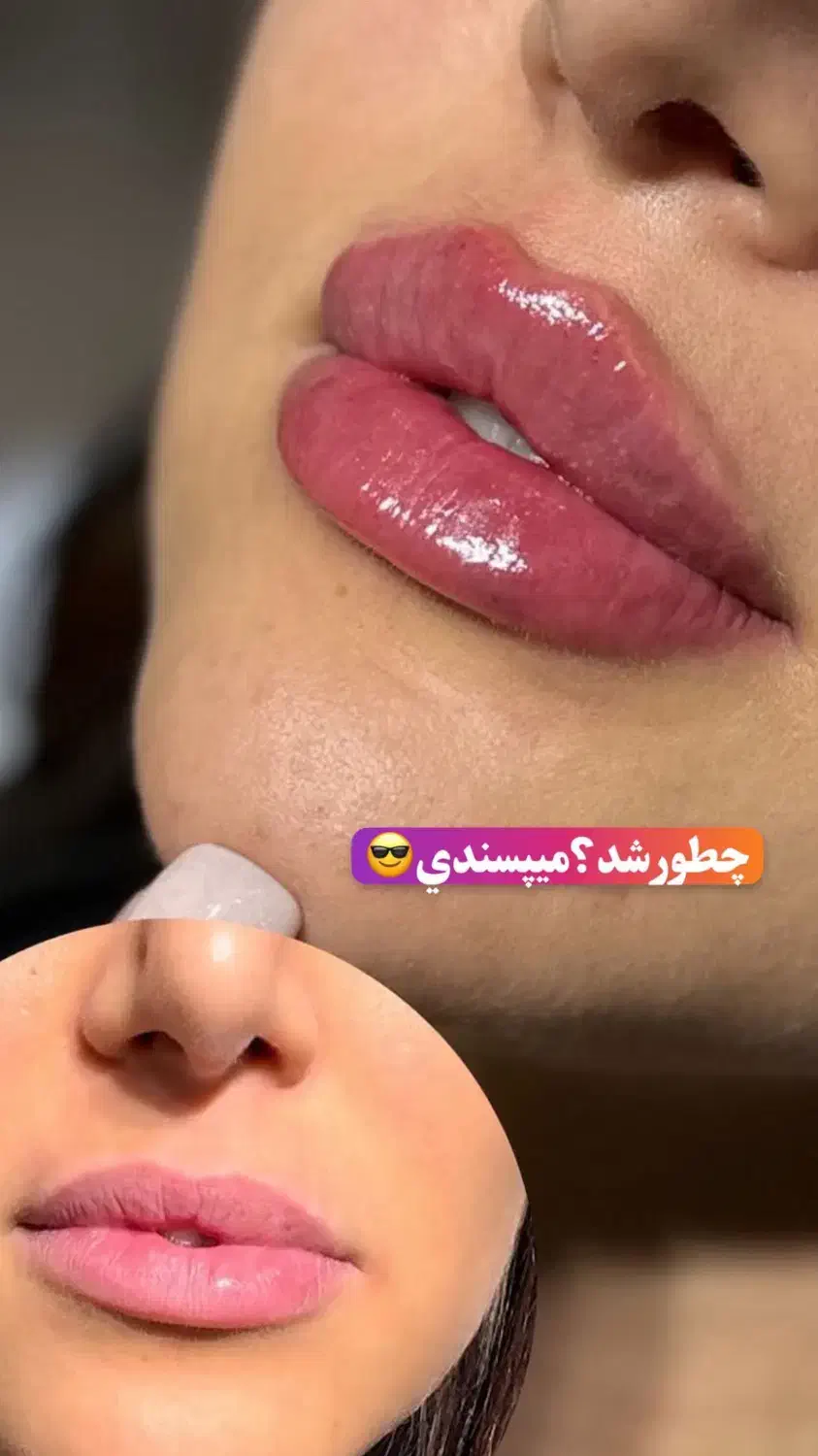 جشنواره تخفیفی ژل و بوتاکس/وام/اقساطی|خدمات آرایشگری و زیبایی|ساری, |دیوار