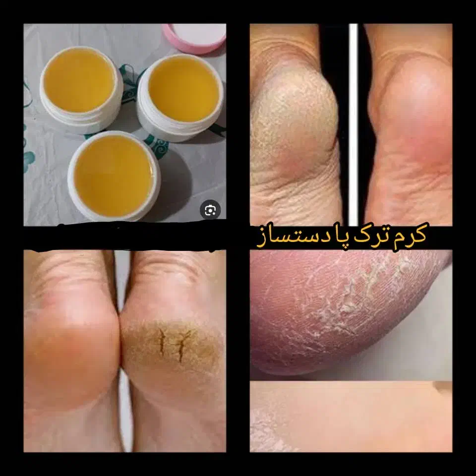 کرم ترک پا گیاهی با جواب دهی 3روزه|آرایشی، بهداشتی، درمانی|سوسنگرد, |دیوار