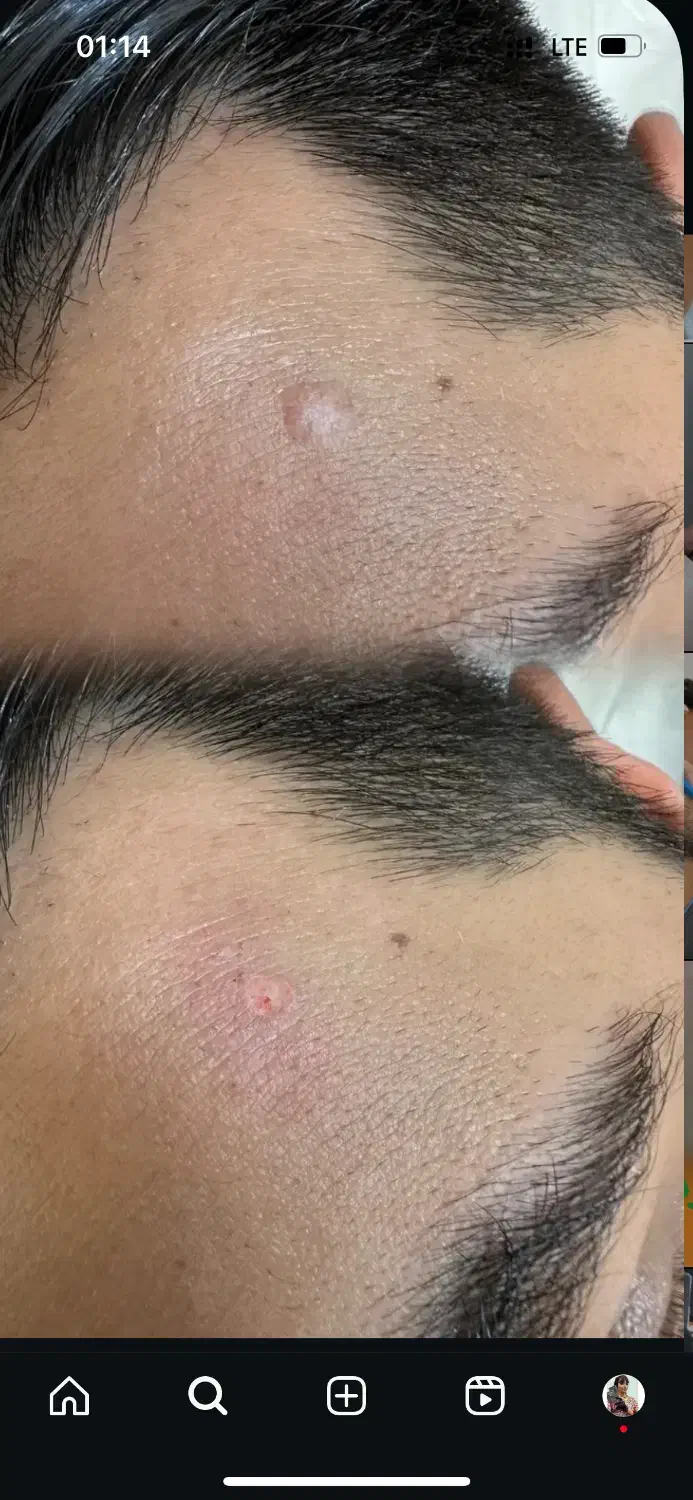 با یک جلسه کک و مکا حذف کن|خدمات آرایشگری و زیبایی|خرم‌آباد, |دیوار