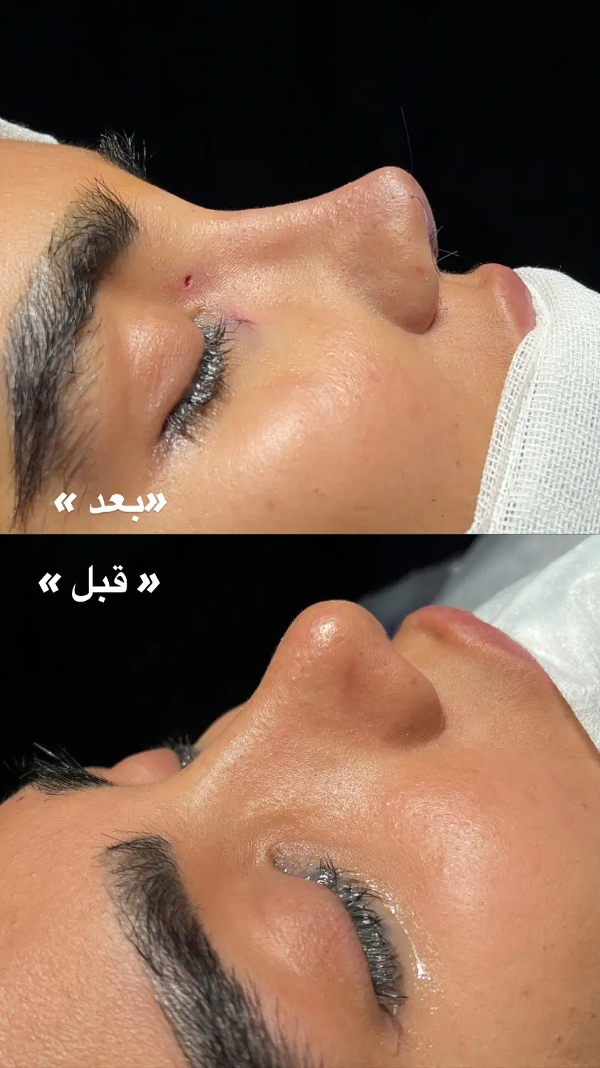 جراحی بینی، پیکر تراشی ترانسفر باسن + شرایط اقساطی|خدمات زیبایی و سلامت|اصفهان, ملکشهر|دیوار