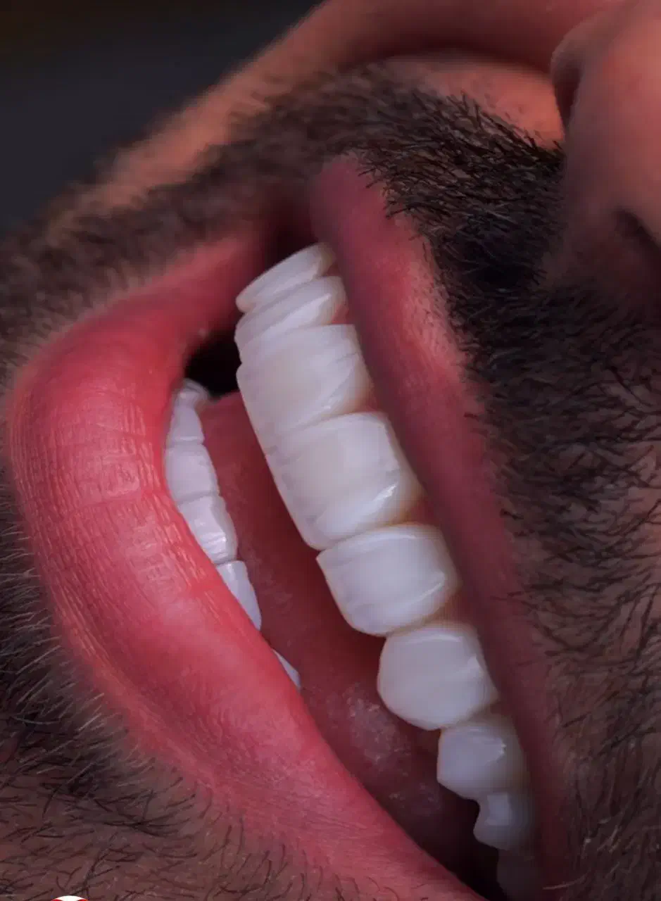 کامپوزیت لمینیت ایمپلنت نقد و اقساط|خدمات آرایشگری و زیبایی|پردیس, فاز ۲|دیوار