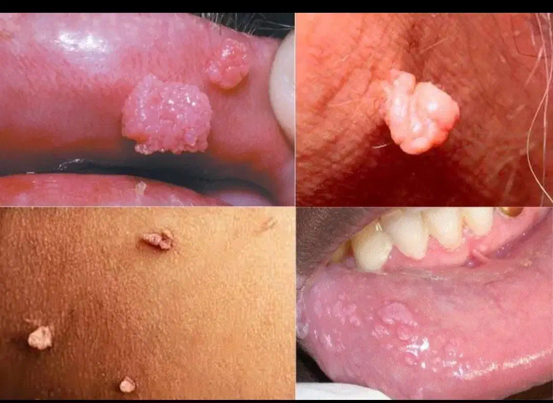 درمان ریشه ای زگیل و تبخال به صورت گیاهی|آرایشی، بهداشتی، درمانی|ساری, |دیوار