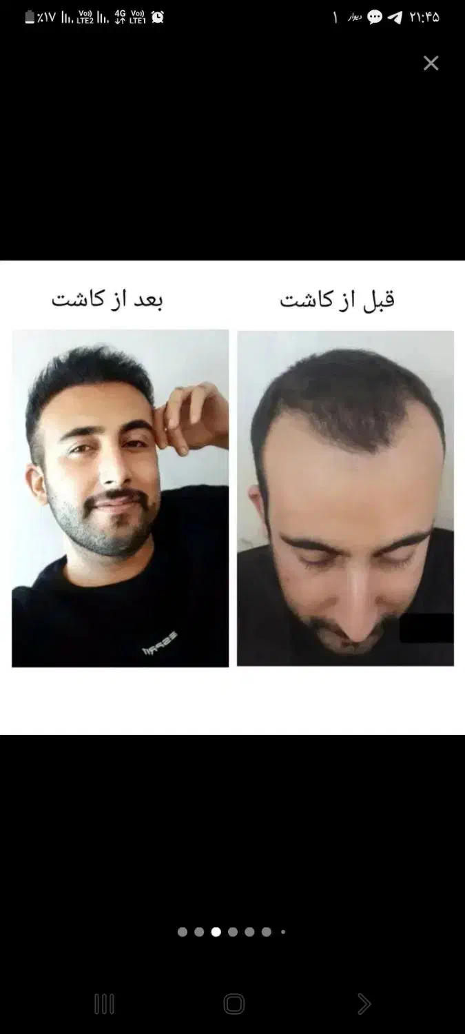 کاشت مو با بالا ترین تراکم و نازلترین قیمت|خدمات آرایشگری و زیبایی|تبریز, |دیوار