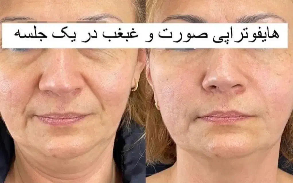 لیزر موهای زائد299هزار، هایفو،سفیدی پوست|خدمات آرایشگری و زیبایی|تبریز, |دیوار