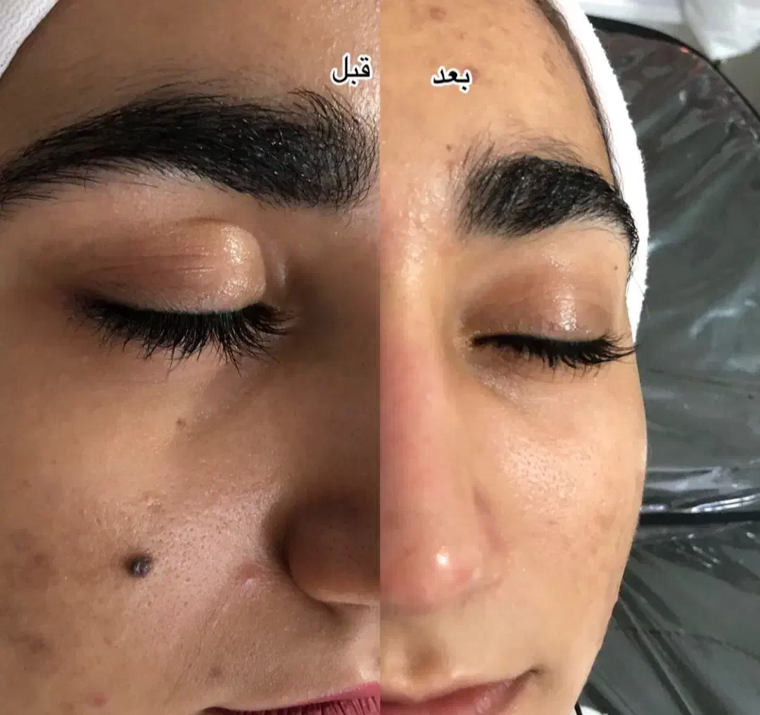 فیشال پوست و کاشت ناخن تضمینی تخفیف یلدایی|خدمات آرایشگری و زیبایی|فردیس, فردیس|دیوار